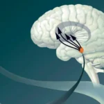 الفقاعات الدقيقة استُخدمت لفتح الحاجز الدموي الدماغي وإيصال الأدوية (غيتي)